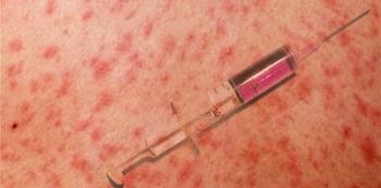 Health Ministry calls for calm, as Measles outbreak is confirmed in Wakiso and Kampala