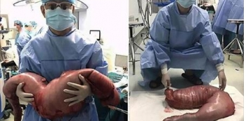 Shocker: Doctors Remove 12 Kg Of Feaces From A Constipated Man