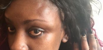 Tycoon SK Mbuga Brutally Beats Leila Kayondo, Disfigures Her Face — Photos