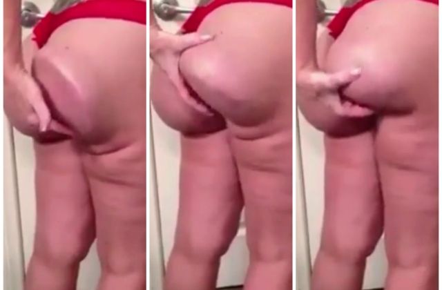 Watch Video ... Woman’s Butt Implant Goes Absolutely Horrible