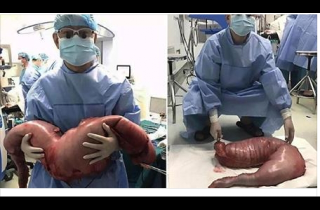 Shocker: Doctors Remove 12 Kg Of Feaces From A Constipated Man