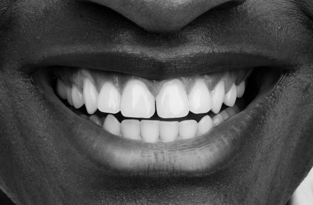 How to Whiten Teeth Naturally